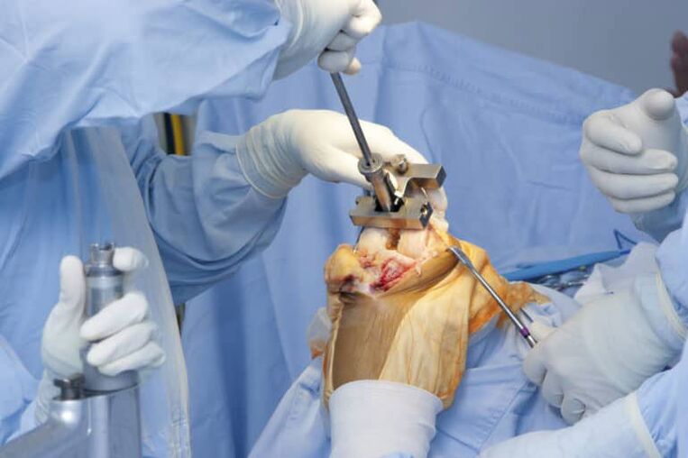 cirurxía de artrose do xeonllo