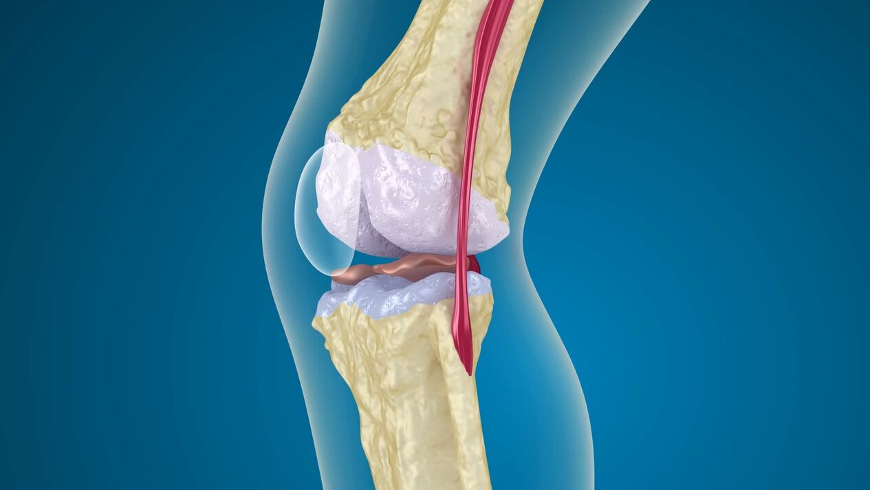 destrución da articulación do xeonllo con artrose