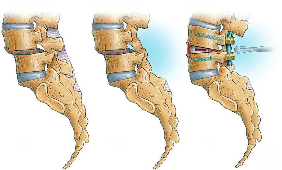 deformidade da columna vertebral