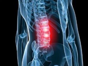Osteocondrose da columna vertebral lumbar