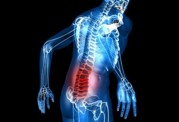 Síntomas da osteocondrose