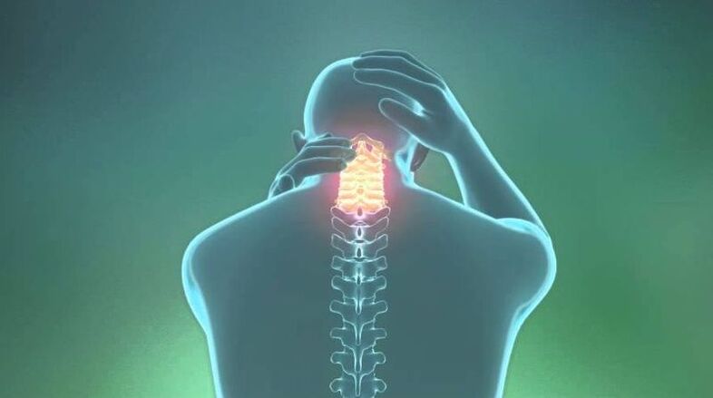 Osteocondrose da rexión cervical