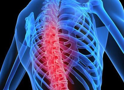 osteocondrose da columna torácica
