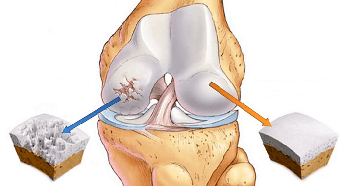 cartilaxe san e cartilaxe afectada pola artrose