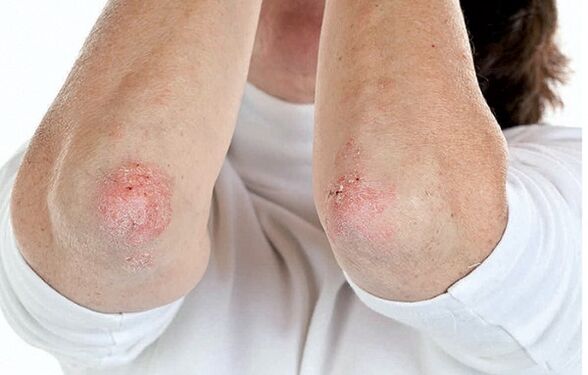 As persoas con psoríase son susceptibles á artrite psoriásica
