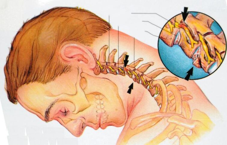 que pasa coa osteocondrose cervical